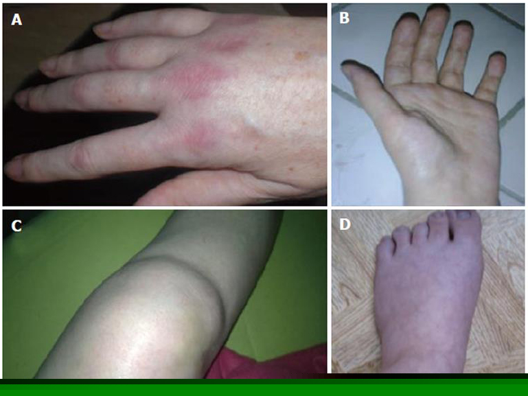 Complex Regional Pain Syndrome